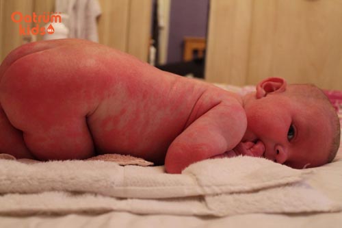 Trẻ nổi mẩn đỏ như mề đay do rôm sảy gây ra