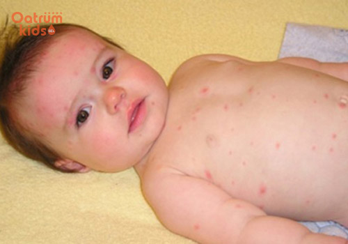 Mẩn ngứa rất thường gặp ở trẻ