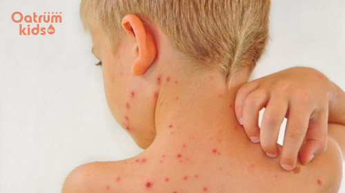 Trẻ mẩn ngứa có thể do nhiều nguyên nhân