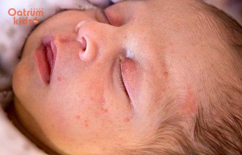 Trẻ bị mẩn đỏ li ti ở trán và mặt rất phổ biến