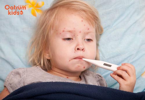 Bé có thể bị sốt phát ban, chân tay miệng, thủy đậu… nếu nổi mẩn đỏ và sốt
