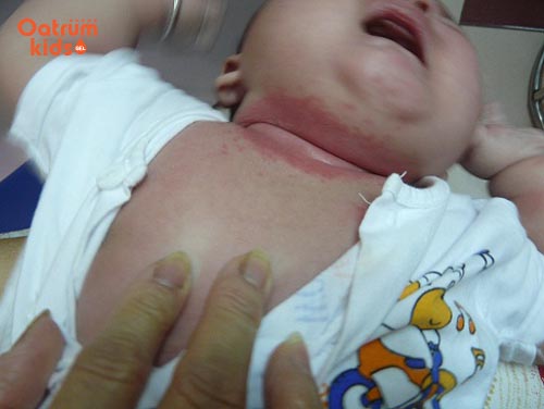 Rất nhiều trẻ sơ sinh bị hăm cổ vì vệ sinh da không đúng cách