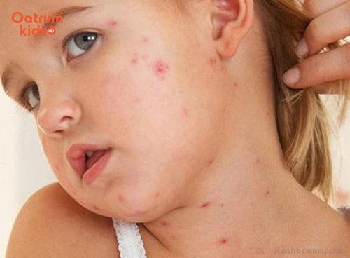 Ban hồng ở trẻ bị rubella