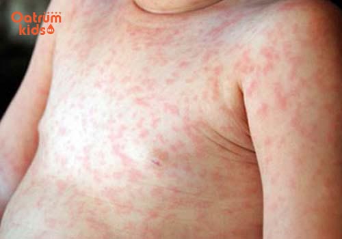 Sau sốt trẻ rất dễ bị mẩn ngứa, phát ban