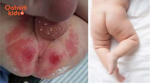 Hạn chế đóng bỉm giúp hăm tã mau khỏi hơn