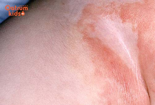 Hăm tã cũng phải kiêng nể chè xanh - Trị hăm tã bằng lá chè xanh