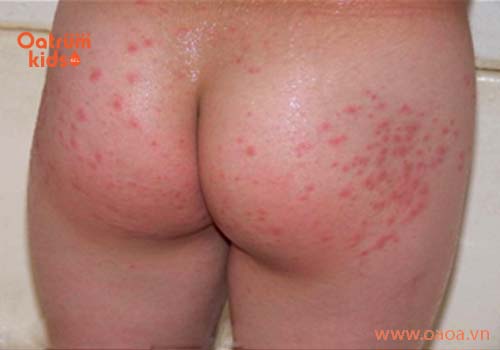 Mụn nhọt ở mông bé có thể do mặc quần chật, đóng bỉm tã quá lâu..