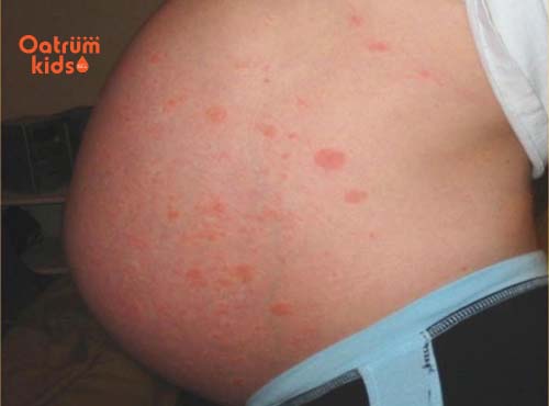 Quần áo giặt không sạch có nhiều chất gây kích ứng