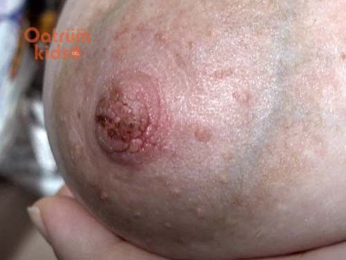 Biểu hiện nứt cổ gà