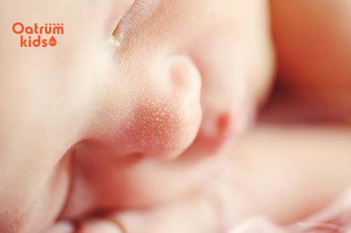 Mụn đầu trắng ở trẻ có thể là mụn sữa, mụn kê, hay nang kê và xuất hiện trong 6 tháng đầu đời ở trẻ sơ sinh