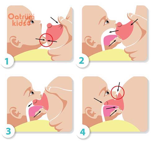 Mẹ bị nứt cổ gà khi cho con bú là do bé bú không đúng cách