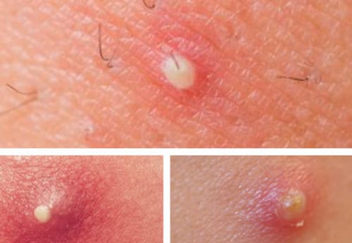 Nổi mụn mủ ở vùng kín do viêm nang lông gây nên