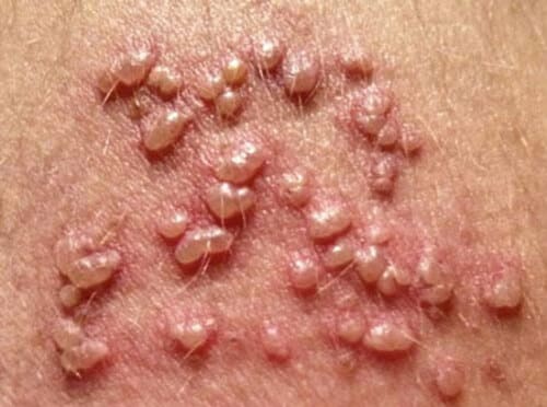Mụn rộp sinh dục do virus Herpes gây nên