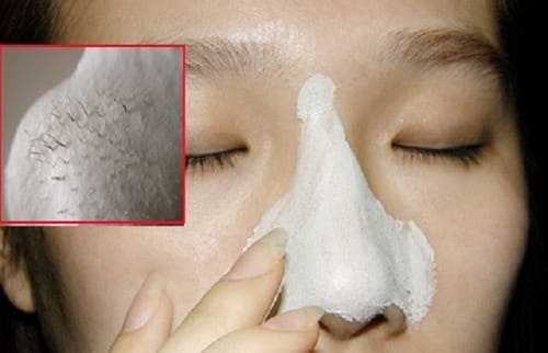 Sử dụng kem trị mụn mủ kém chất lượng khiến tình trạng mụn thêm nặng