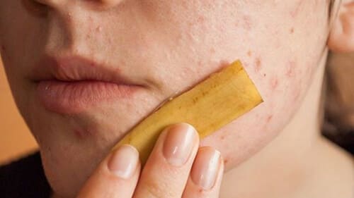 Vỏ chuối có chứa chất chống oxyx hóa mạnh nên giúp giảm nhanh mụn trứng cá