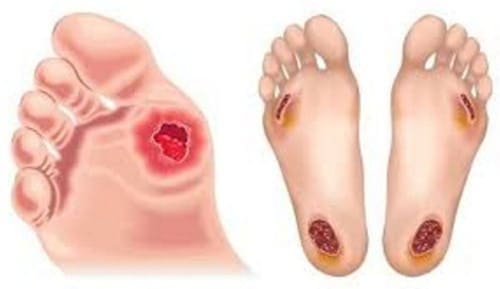 Vùng da bàn chân bị chảy nước, xuất hiện mô đen bao quanh