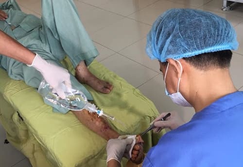 Vết loét sâu, rộng cần được bác sĩ chuyên khoa xử lý