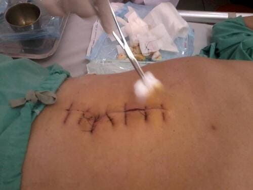 Vết thương sau mổ cần được chăm sóc hàng ngày để tránh nhiễm trùng