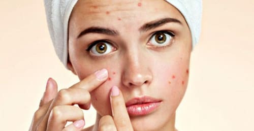 Vết thâm hình thành sau mụn mủ do nặn mụn không đúng cách