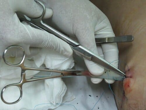 Cắt chỉ vết thương không gây đau đớn