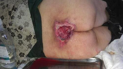 Vết loét lâu lành do mắc bệnh tiểu đường