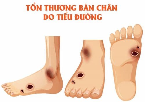 Triệu chứng loét bàn chân do tiểu đường