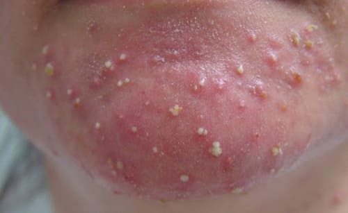 Mụn mủ thường xuất hiện ở những vùng da tiết nhiều bã nhờn