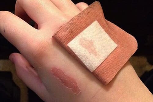 Dầu mù u phù hợp trị vết thương hở nhẹ, không nên dùng cho vết thương loét, mưng mủ