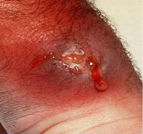 Vết thương chảy mủ và có mùi hôi