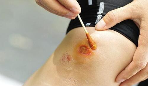 Rửa sạch vết thương bằng dung dịch sát khuẩn