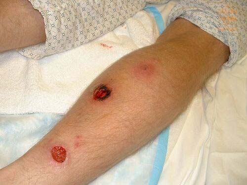 Vết loét da do tổn thương hệ thống tuần hoàn