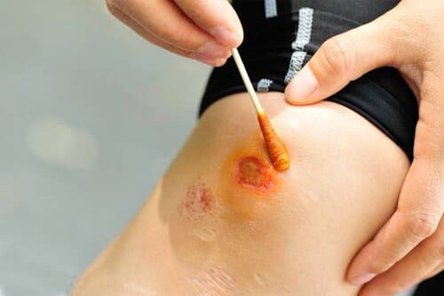 Oxy già, nước muối sinh lý, thuốc đỏ, thuốc tím… là các loại thuốc sát trùng vùng da bị loét