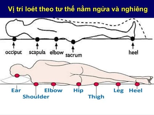 Vết loét thường xuất hiện ở vùng da chịu áp lực tỳ đè