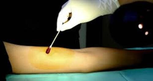 Thuốc sát trùng vết loét cần tiêu diệt được các loại vi khuẩn