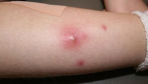 Mụn mủ ở chân gây sưng, đỏ, đau, thời gian điều trị kéo dài