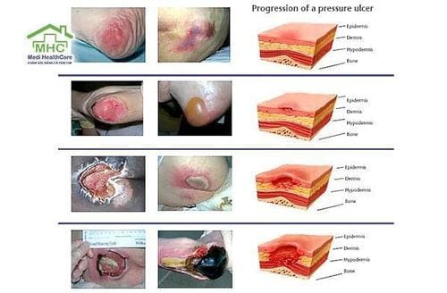 Vết loét do tỳ đè gồm 4 cấp độ