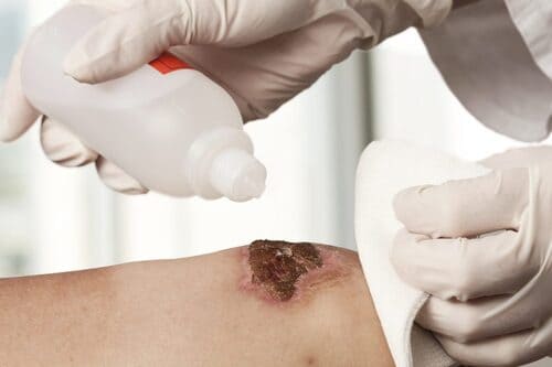 Dùng nước muối sinh lý kháng khuẩn vết loét do tỳ đè