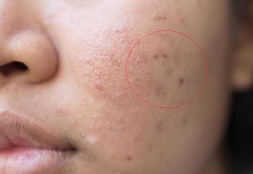 Nặn mụn mủ không đúng cách có thể để lại thâm sẹo xấu xí