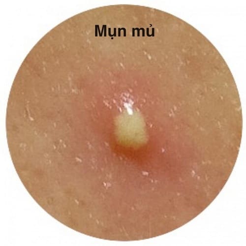 Khi làn da bị vi khuẩn xâm nhập gây bít tắc lỗ chân lông sẽ hình thành mụn mủ