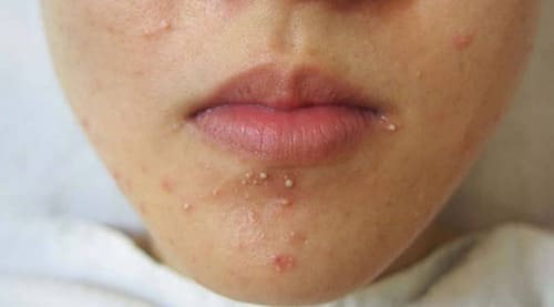 Mụn mủ mọc quanh miệng đến từ nhiều nguyên nhân khác nhau
