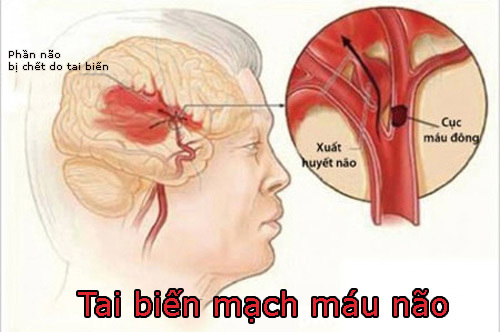 Tai biến mạch máu não có tỷ lệ tử vong cao