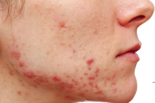 Không nên tự ý sử dụng thuốc nội tiết trị mụn trứng cá khi chưa có chỉ định từ bác sĩ