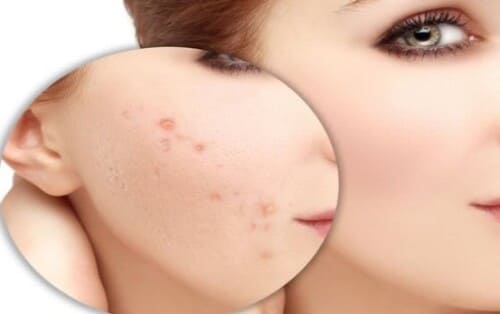 Mụn mủ ở mặt nếu không điều trị đúng cách có thể để lại sẹo và vết thâm