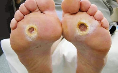 Loét da do tì đè ở người mắc tiểu đường