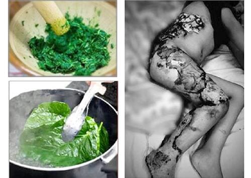 Tự ý đắp thuốc nam khiến vết bỏng bị hoại tử
