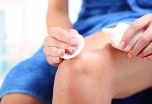 Dùng oxy già sát trùng vết bỏng gây nhiễm trùng, hoại tử