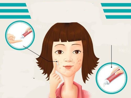 Kem đánh răng có thể khiến tình trạng mụn trứng cá thêm trầm trọng hơn