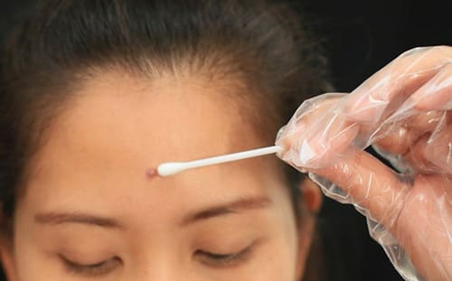 Chỉ nên dùng hồ nước với các loại mụn nhỏ, mới mọc, số lượng ít