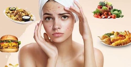 Lối sống không lành mạnh là nguyên nhân gây mụn mủ