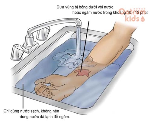 Sơ cứu hạ nhiệt cho vết bỏng giúp ngăn ngừa tổn thương sâu, rộng
